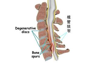 腰椎管狭窄的常见病因有哪些