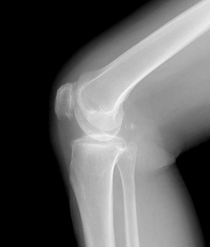 膝关节骨质增生会带来哪些影响