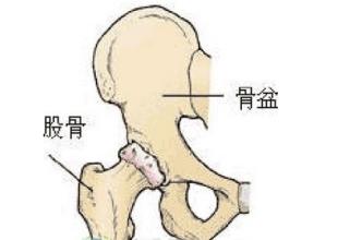 为什么骨坏死容易发生在股骨头